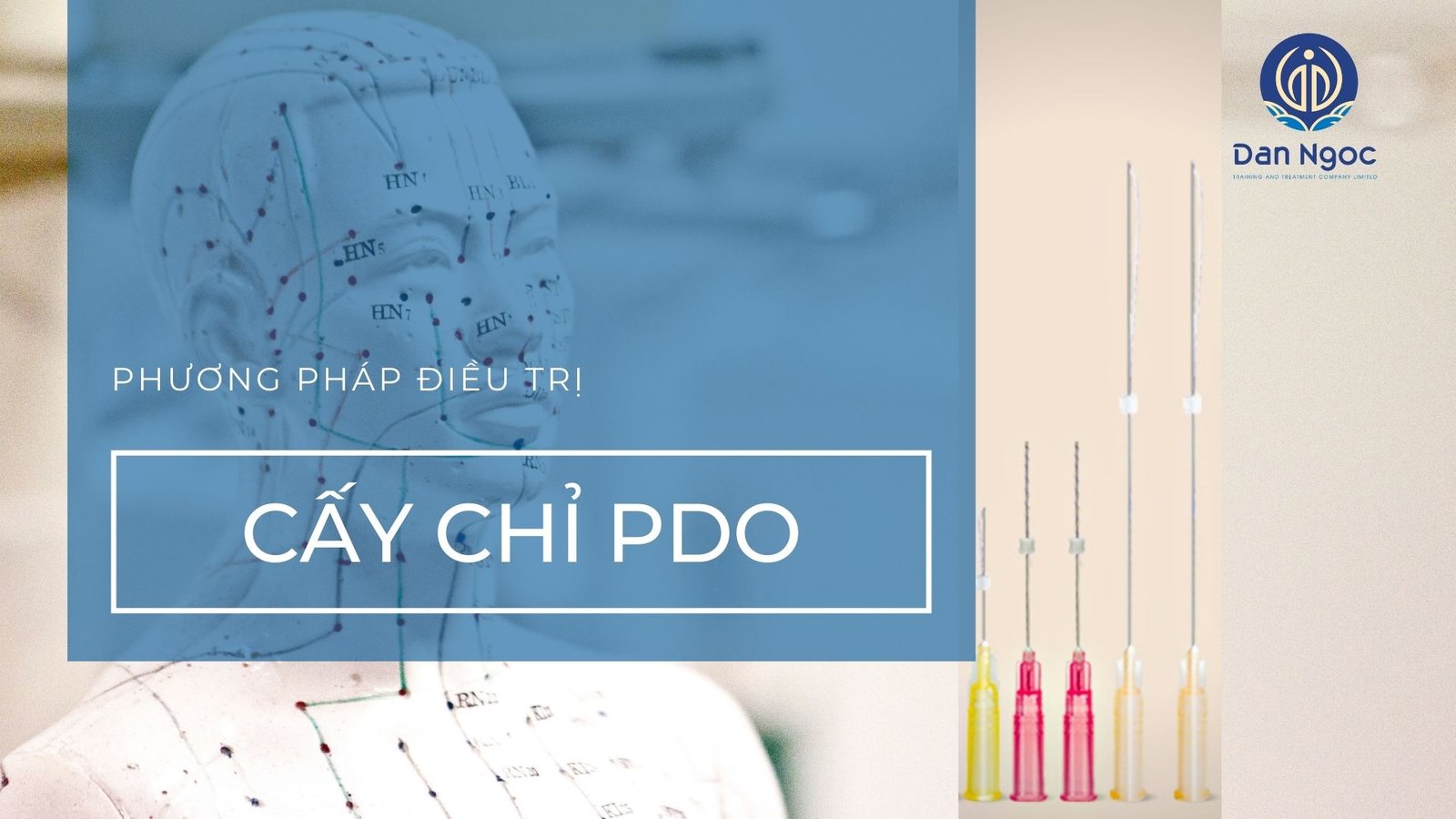Cấy chỉ điều trị bệnh