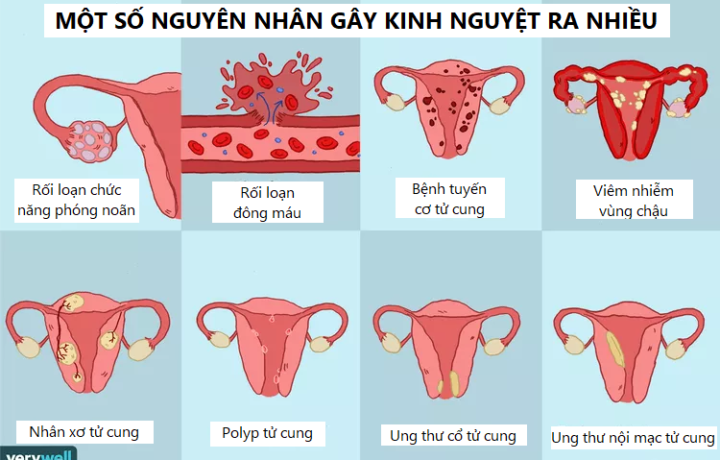 Vì sao kinh nguyệt ra nhiều
