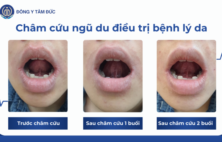 Châm cứu ngũ du điều trị bệnh lý về da