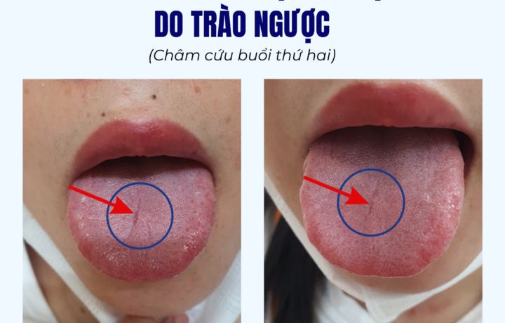 Châm cứu điều trị viêm họng do trào ngược
