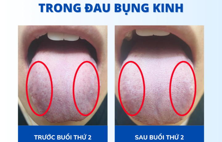 Điều trị kinh lạc trong đau bụng kinh