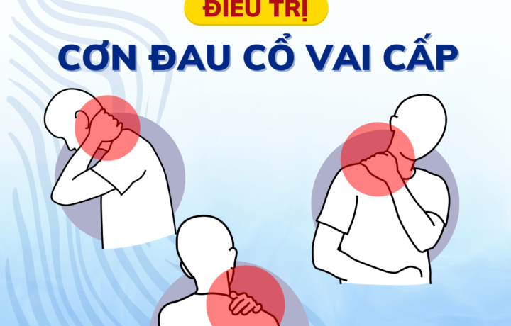 Điều trị cơn đau cổ vai cấp