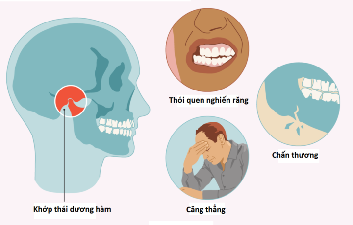 Những thói quen xấu khiến bạn dễ đau khớp hàm