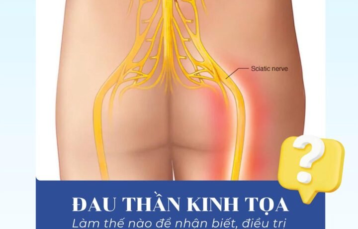Phòng ngừa nỗi đau mang tên "Thần kinh tọa"