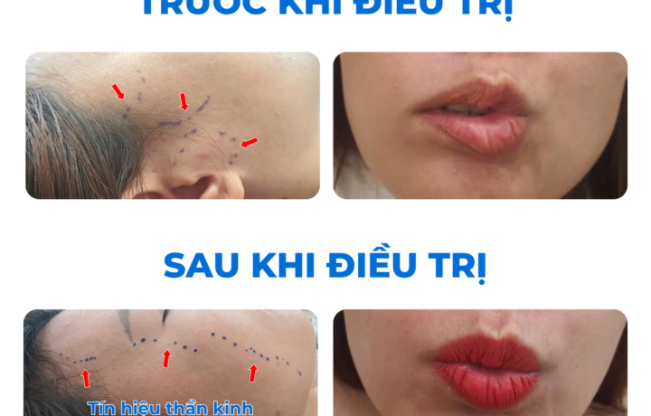 Liệt Mặt Ngoại Biên: Đừng Để Nụ Cười Bị Lấy Mất!