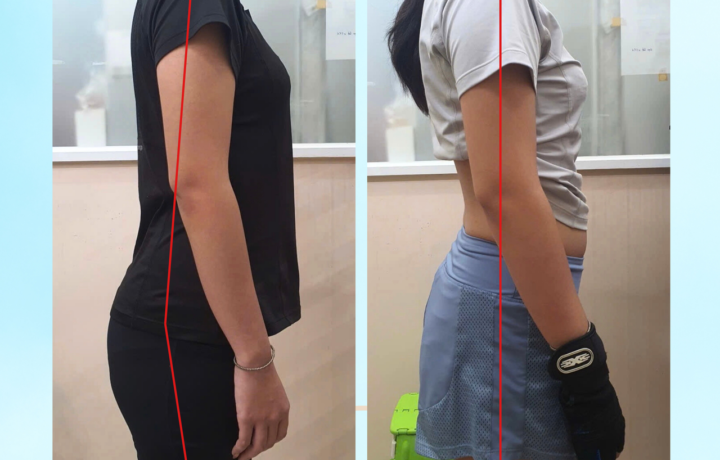 "Cải thiện đường cong sinh lý: Điều trị kết hợp Applied Kinesiology và Schroth"
