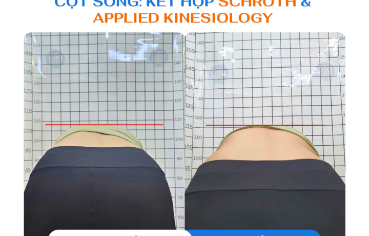 Chìa khóa mới thay đổi vẹo cột sống: Sự kết hợp Schroth & Applied Kinesiology