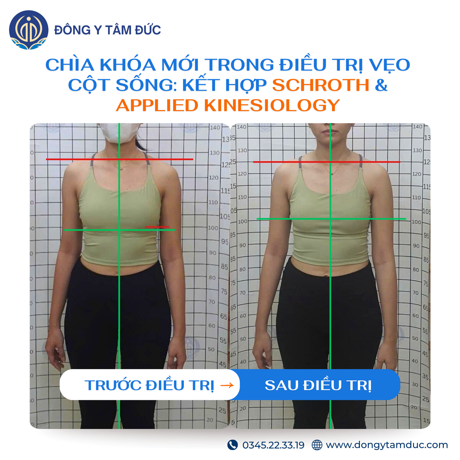 Chìa khóa mới thay đổi vẹo cột sống: Sự kết hợp Schroth & Applied Kinesiology