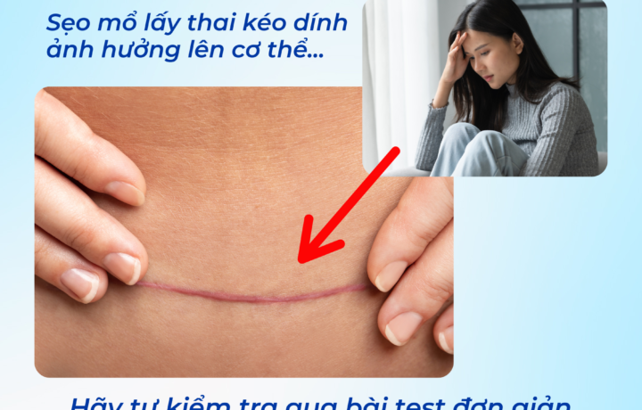 Sẹo mổ lấy thai kéo dính – ảnh hưởng đến đau lưng, tiểu tiện và năng lượng hằng ngày